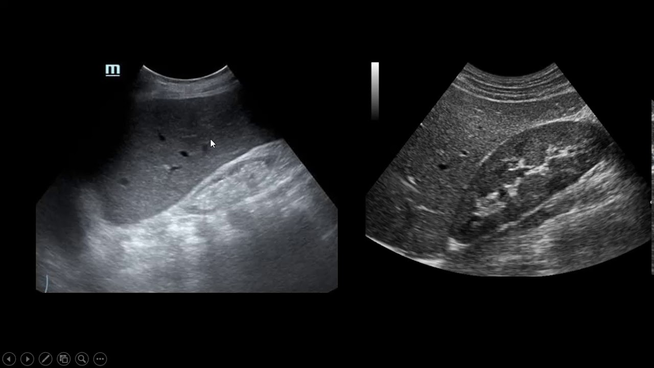 Entenda a Doença Renal Crônica Causas Sintomas e Tratamentos