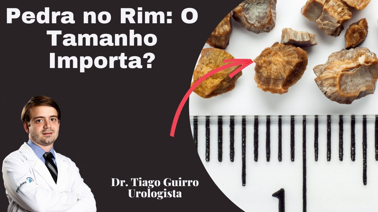 Pedra Nos Rins A Import Ncia Do Tamanho