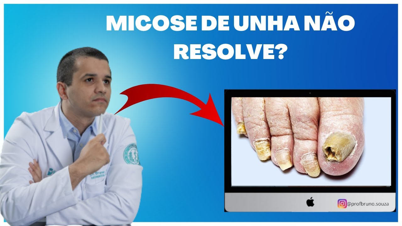 Tratamento Eficaz Para Micose De Unha Com Dr Bruno Souza Dermatologista