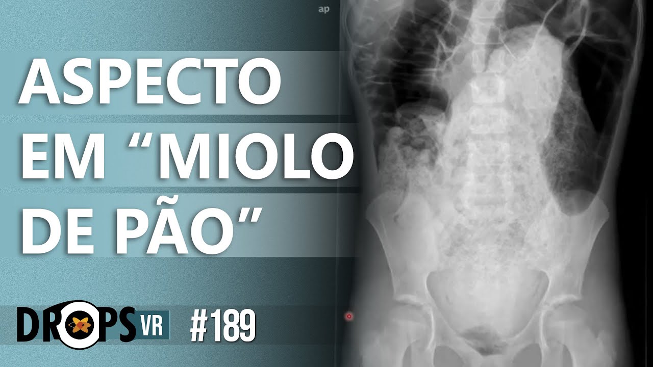 Descubra o que é o aspecto em miolo de pão no raiox