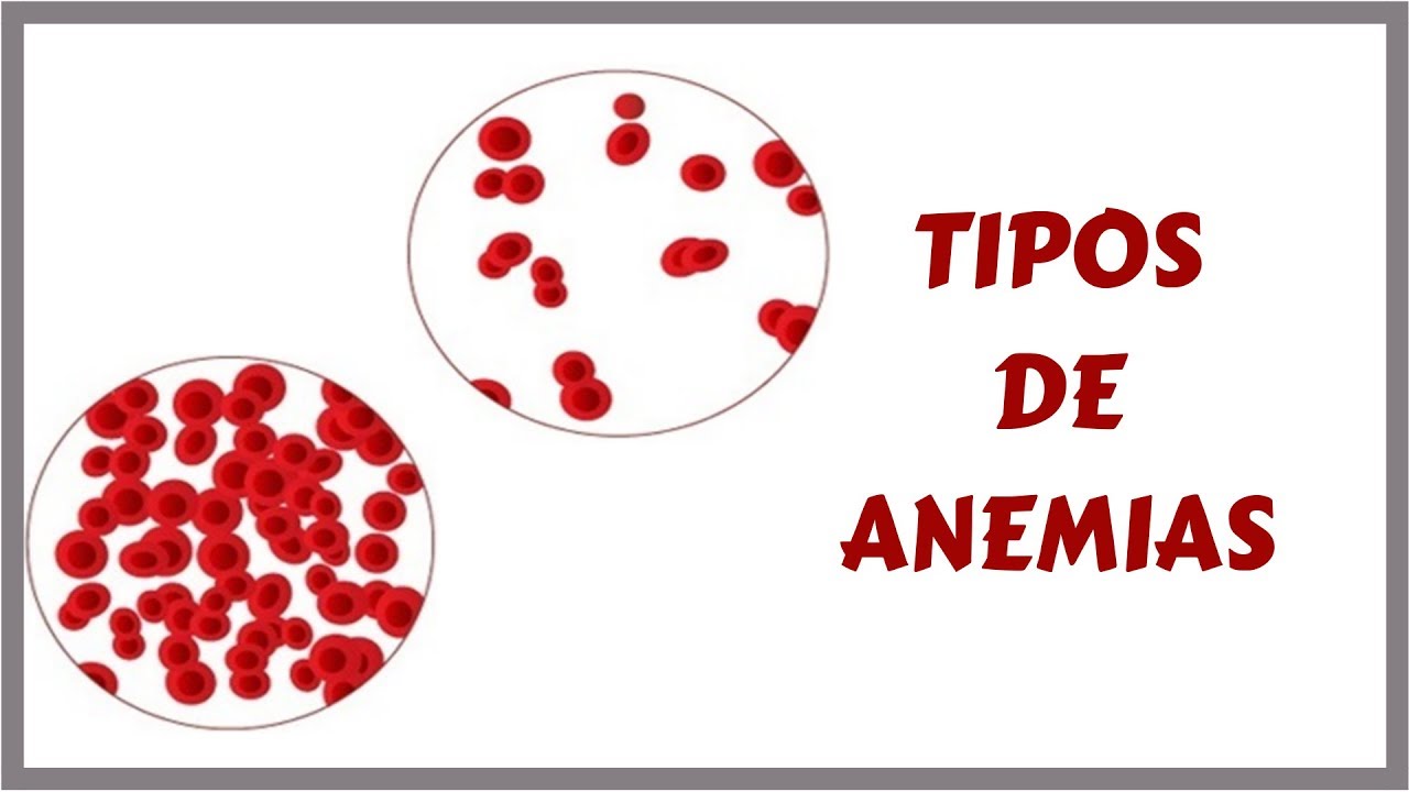 Anemias Tipos Sinais Sintomas E Tratamento 